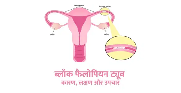 Fallopian Tube in Hindi – ब्लॉक फैलोपियन ट्यूब के कारण, लक्षण और उपचार