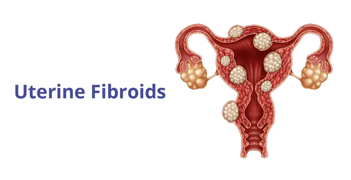 Uterine Fibroids: Symptoms, Causes, Types & Treatment