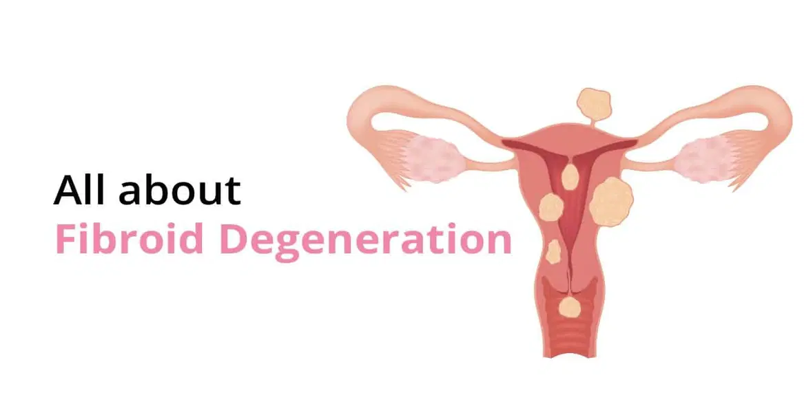 What is Fibroid Degeneration? Types, Causes & Symptoms