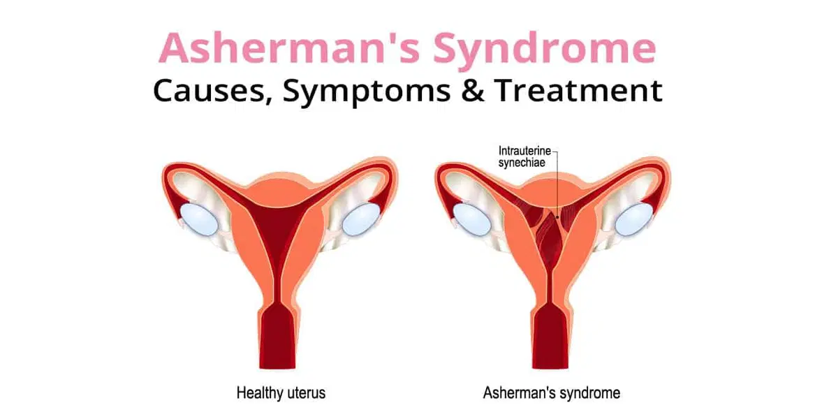 Asherman’s Syndrome: Causes, Symptoms & Treatment