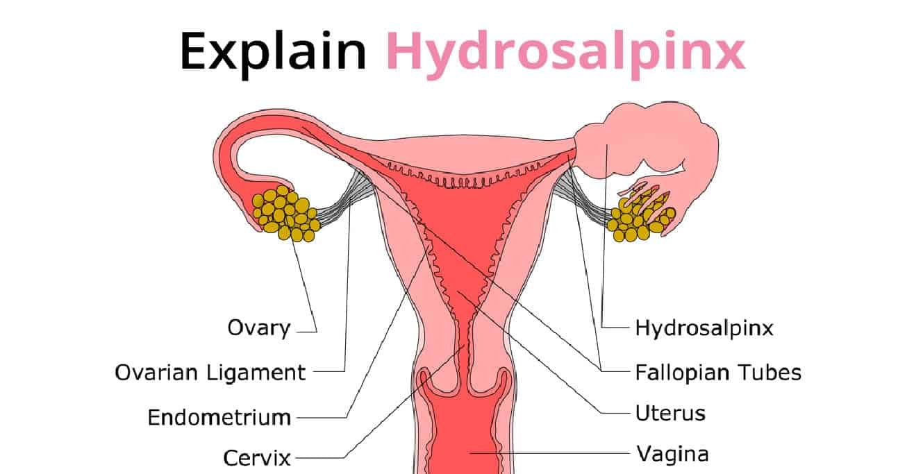 Hydrosalpinx: Causes, Symptoms, Diagnosis & Treatment