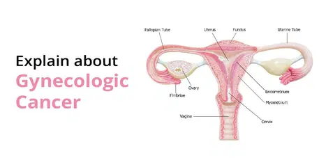 എന്താണ് ഗൈനക്കോളജിക്കൽ ക്യാൻസറും അതിന്റെ തരങ്ങളും