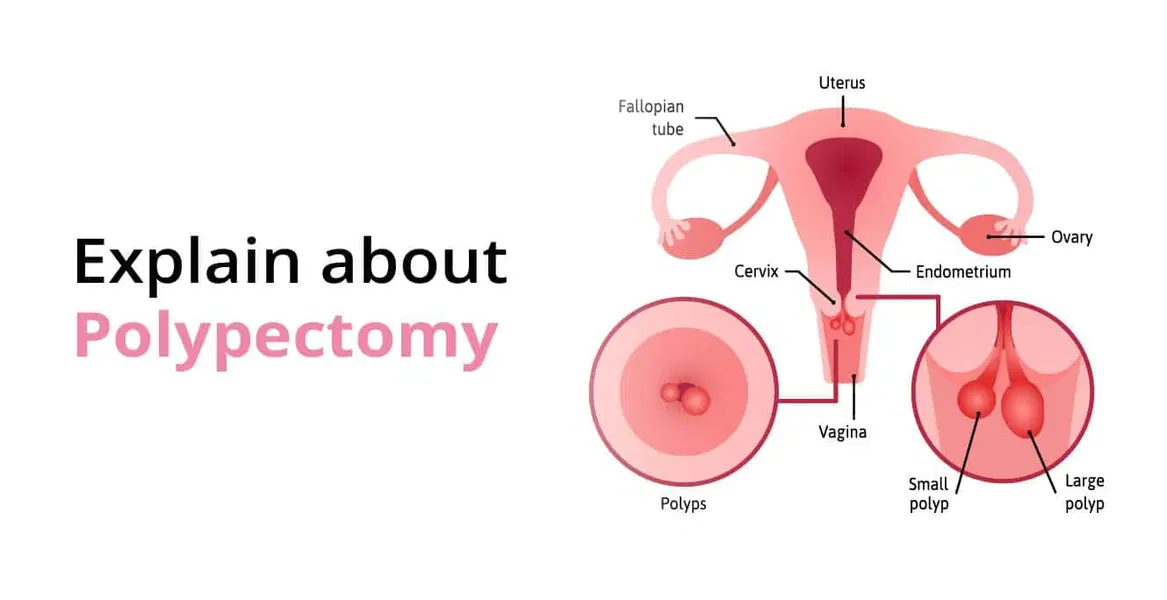 Polypectomy – Can Removing Polyps Improve Pregnancy Chances?