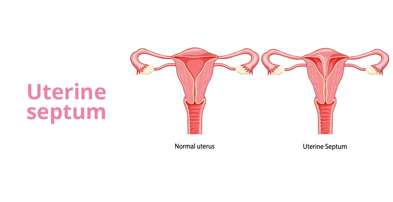 Uterine Septum: Symptoms, Causes, and Treatment