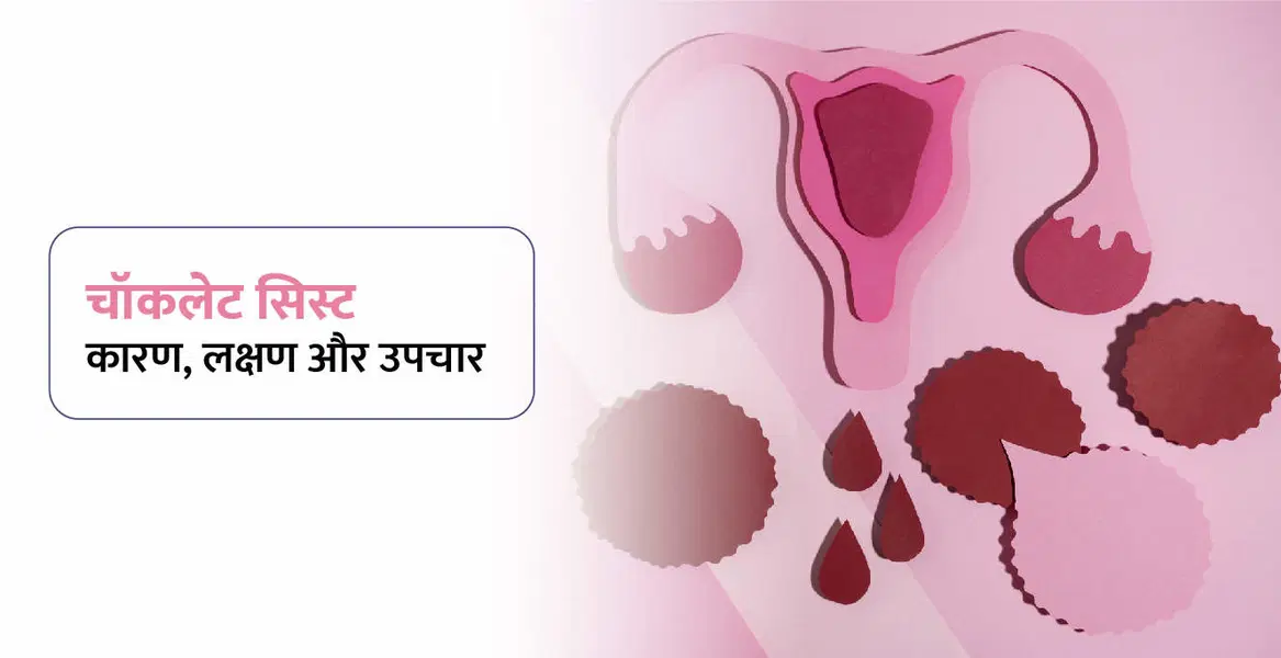 Chocolate Cyst Meaning in Hindi – चॉकलेट सिस्ट क्या है? कारण, लक्षण और उपचार