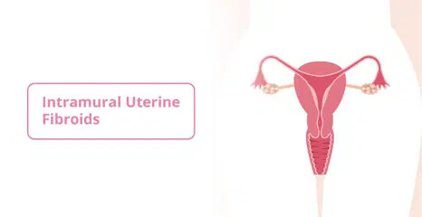 Intramural Uterine Fibroids: Causes, Symptoms and Treatment