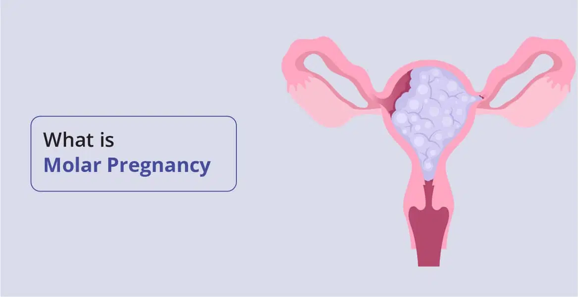 Molar Pregnancy: Causes, Symptoms, and Treatments